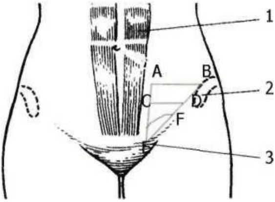 1 — прямая мышца живота; 2 — передняя верхняя подвздошная ость; 3 — лобковый бугорок; ABЕ — паховая область; CDE — паховый треугольник; EF — паховый промежуток; BE — проекция паховой связки; AE — проекция латерального края прямой мышцы живота