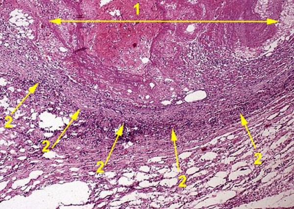 Смешанный тромб. Тромб (1) в просвете сосуда, в стенке которого воспалительная инфильтрация (2)