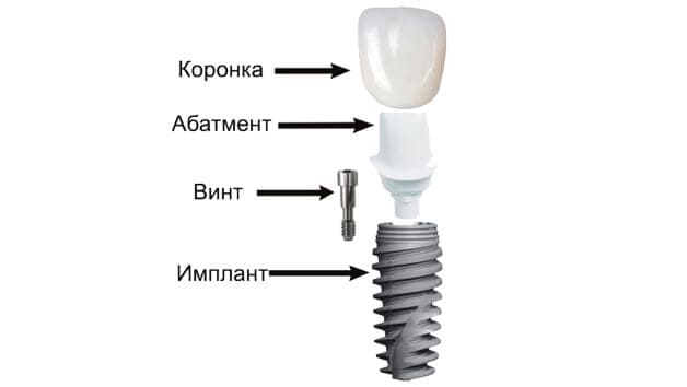 Составные элементы дентального имплантата