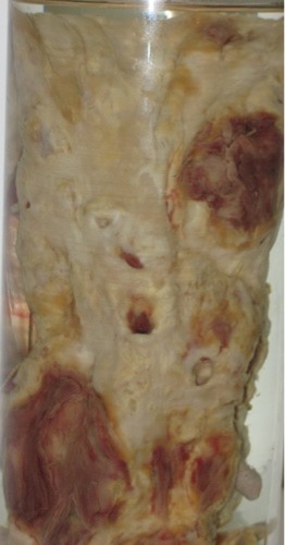 Атеросклероз аорты. В аорте со стороны эндотелия определяются множественные фиброзные бляшки, в том числе с обызвествлением, атероматозом и тромботическими наложениями