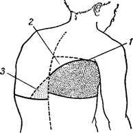 Экссудативный плеврит: 1 – линия Дамуазо, 2 – треугольник Гарлянда, 3 – треугольник Раухфуса-Грокко