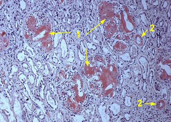 Амилоидоз почки (окраска Конго-рот). При окраске конго-красным амилоид выявляется в клубочках (1) и по ходу сосудов (2)