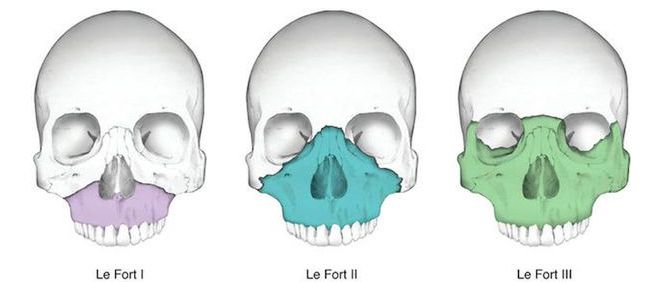 Типы переломов верхней челюсти по Le Fort