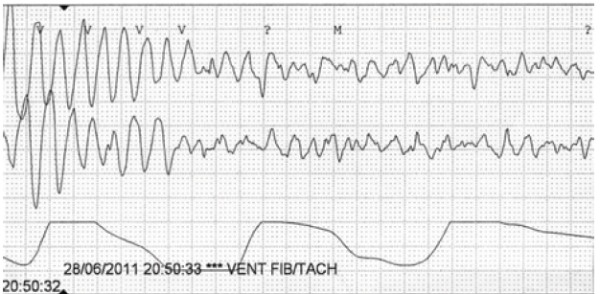 Трепетание желудочков (регулярные, схожие по морфологии волны частотой около 300/мин, образующие синусоиду) переходит в фибрилляцию желудочков (нерегулярные, различной амплитуды и формы волны с частотой 300-500/мин).