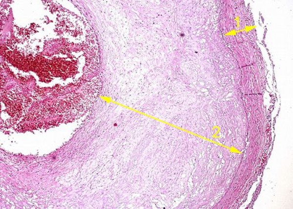 Атеросклероз венечной артерии. В просвете артерии (1 – её стенка) находится бляшка (2), суживающая её просвет