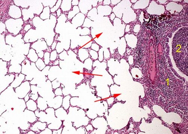 Эмфизема легких. Межальвеолярные перегородки истончены, альвеолы сливаются в крупные полости. В стенке бронхов гнойный инфильтрат (1), в просвете - экссудат