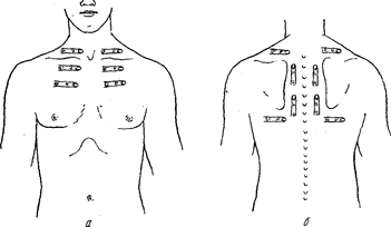 Схема сравнительной перкуссии легких: а – по передней, б – по задней поверхности грудной клетки.