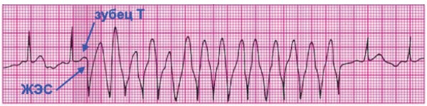 Пароксизм неустойчивой желудочковой тахикардии, запущенный желудочковой экстрасистолой
