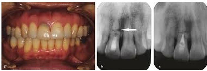 Перелом корня зуба