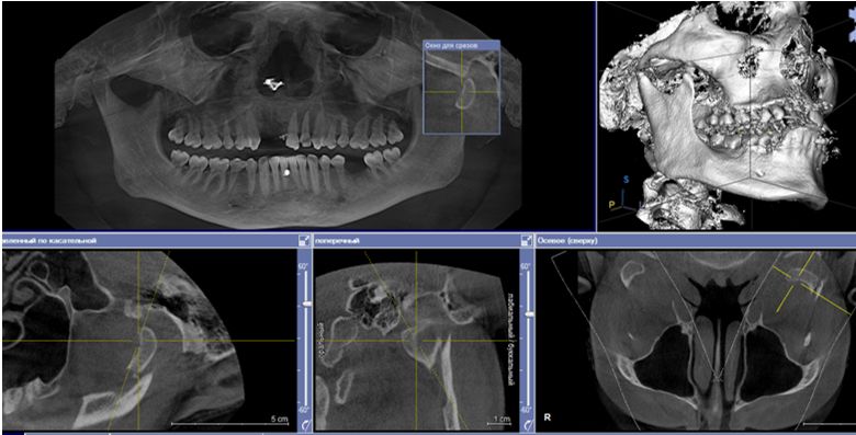 Перелом мыщелкового отростка нижней челюсти слева со смещением отломков