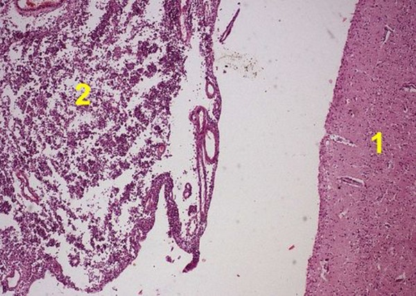 Гнойный менингит. В препарате ткань мозга (1) и мягкая мозговая оболочка (2) с лейкоцитарной инфильтрацией