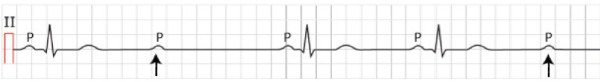 АВ-блокада II степени Мобитц 2: блокада проведения предсердного импульса на желудочки (↑) и выпадение отдельных комплексов QRS без предшествующего удлинения интервалов PR