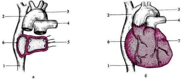 а — общий вид после удаления сердца реципиента; б — вид после трансплантации сердца; 1 — нижняя полая вена; 2 — верхняя полая вена; 3 — аорта; 4 — легочная артерия; 5 — задняя стенка левого предсердия; 6 — задняя стенка правого предсердия (реципиента); 6 — правое предсердие донорского сердца; 7 — пересаженное донорское сердце