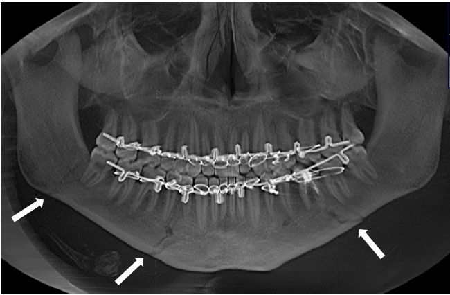 Множественный перелом нижней челюсти во фронтальном отделе справа, в области тела слева, в области угла справа без смещения костных отломков, выполнено бимаксиллярное шинирование