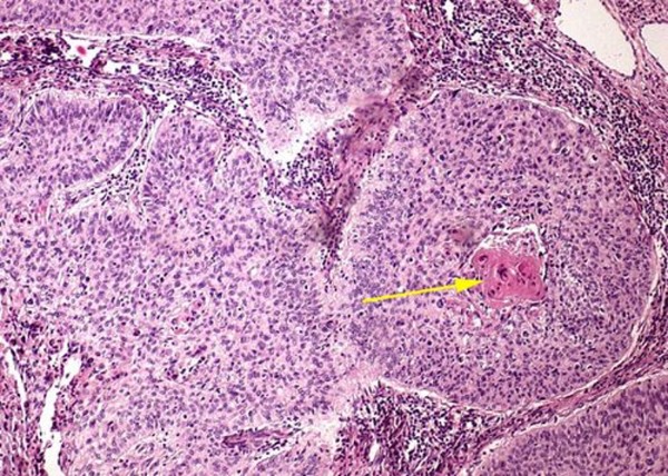 Плоскоклеточный неороговевающий рак. Опухолевые клетки формируют комплексы, в глубине которых встречаются раковые «жемчужины» (стрелка)