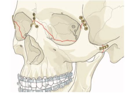 Фиксация перелома верхней челюсти по типу Ле Фор III