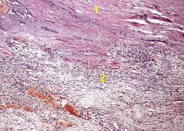 Инфаркт миокарда. Зона некроза (1) окружена зоной перифокального воспаления с паретически расширенными сосудами (2)