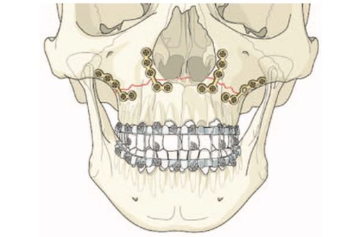 Фиксация перелома верхней челюсти по типу Ле Фор I