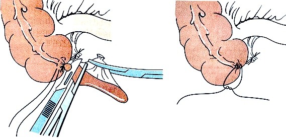 Этапы выполнения открытой аппендэктомии © Thieme. Henne-Bruns D. Chirurgie 2012