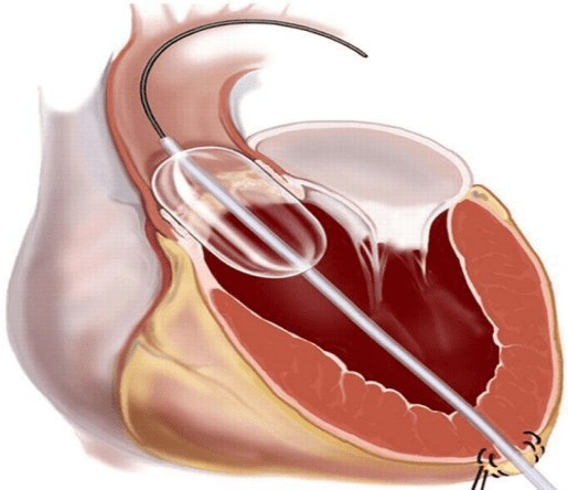 Баллонная комиссуротомия 