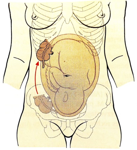 Краниальное смещение аппендикса на поздних сроках беременности
