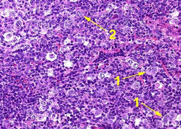 Лимфогранулематоз. В ткани лимфоузла встречаются клетки Рид-Штернберга (1) и большие клетки Ходжкина (2)