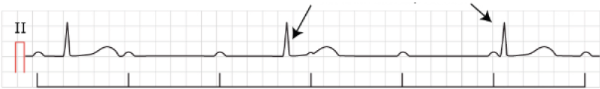 АВ-блокада III степени: электрическая активность предсердий (зубцы Р) и желудочков (↓ – замещающий ритм из АВ-соединения) никак не связаны между собой