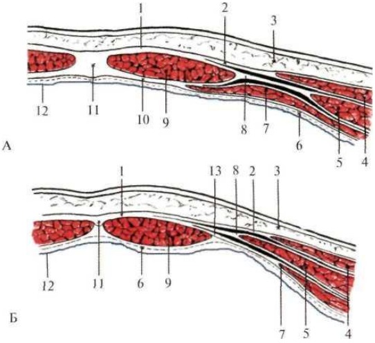 А — выше пупка; Б — ниже пупка; 1 — передняя стенка влагалища прямой мышцы живота; 2 — апоневроз наружной косой мышцы живота; 3 — кожа и ПЖК; 4 — наружная косая мышца живота; 5 — внутренняя косая мышца живота; 6 — поперечная фасция; 7 — поперечная мышца живота; 8 — апоневроз внутренней косой мышцы живота; 9 — прямая мышца живота; 10 — задняя стенка влагалища прямой мышцы живота; 11 — белая линия живота; 12 — париетальная брюшина; 13 — апоневроз поперечной мышцы живота 