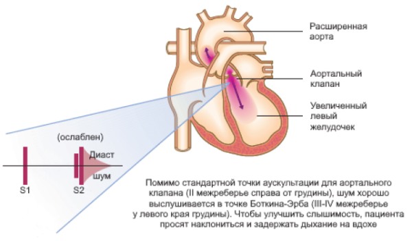 Аускультативные феномены при аортальной недостаточности