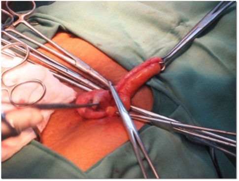 Острый флегмонозный аппендицит во время открытой аппендэктомии