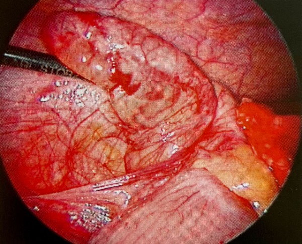 Флегмонозно-фибринозный аппендицит во время лапароскопической аппендэктомии