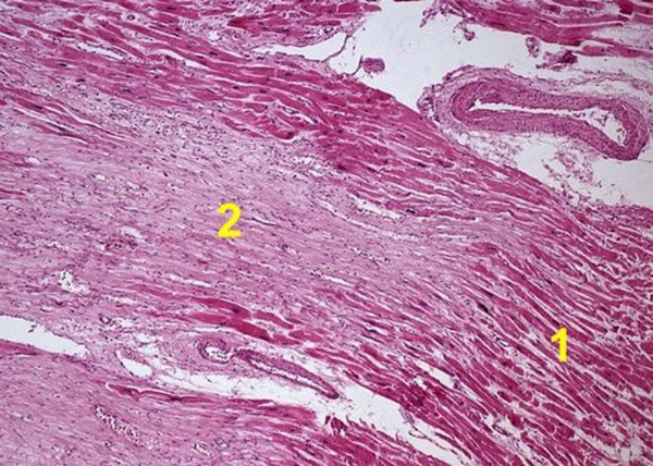 Крупноочаговый кардиосклероз. Между волокнами миокарда (1) участки соединительной ткани (2)