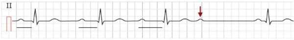 АВ-блокада II степени Мобитц 1: поступательное удлинение интервала PR с последующей блокадой проведения предсердного импульса на желудочки (↓) с выпадением QRS